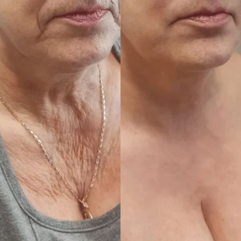 Before and after with XeiuC Collagen Oil